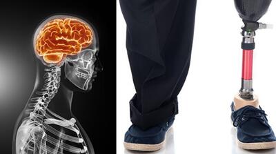  این مرد از پزشکان خواست دو انگشتش را قطع کنند! ؛ ماجرا چه بود؟