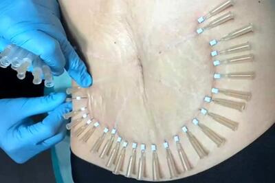  راهنمای کامل امبدینگ (لاغری با نخ) : نحوه انجام، کاربردها، و هزینه