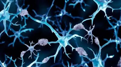  چرا آلزایمر کمتر سراغ مبتلایان به سرطان می‌رود؟