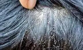  شپش سر در کودکان: علائم اصلی و راه های اصولی درمان آن