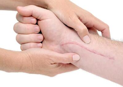  از بین بردن جای زخم بخیه جراحی | بررسی بهترین روش‌های علمی و پزشکی