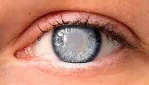  سن ابتلا به آب‌مروارید پایین آمده