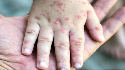  سرخک دوباره برگشت! / سازمان جهانی بهداشت هشدار داد