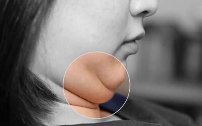 غبغب چیست و چطور آن را از بین ببریم؟ دلایل ایجاد غبغب