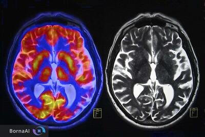 یائسگی چگونه مغز را تغییر می‌دهد؟