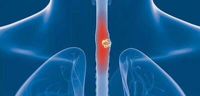 علائم پنهان سرطان مری/ چرا نباید چای داغ بنوشید؟