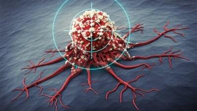 کاهش سن ابتلا به سرطان در ایران