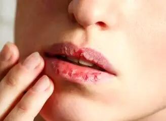 علت ترک در اطراف دهان و لب‌های پوسته پوسته چیست؟