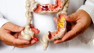 مهم ترین عوامل بروز سرطان روده را بشناسید