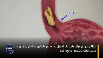  چه عواملی باعث سرطان مری می‌شود؟