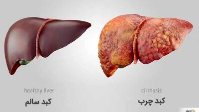 متخصص گوارش: کبد چرب و بسیاری بیماری‌های گوارشی اغلب بی‌علامت‌اند