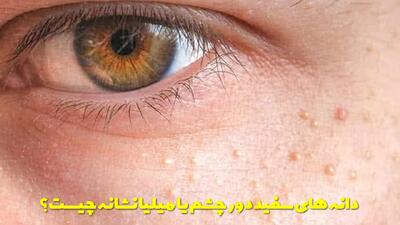  دانه های سفید دور چشم یا میلیا نشانه چیست؟ درمان خانگی میلیا دور چشم