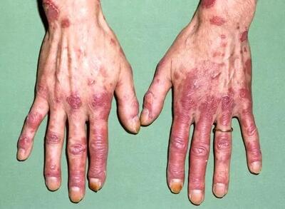 لوپوس در کودکان خطرناک‌تر و پیشرونده‌تر است