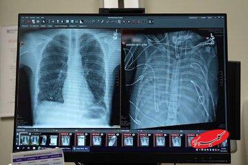  مردی ۴۸ ساعت بدون ریه زنده ماند - کلبه سرگرمی