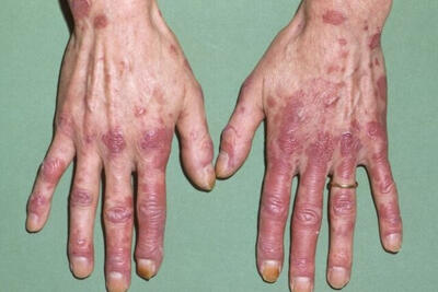 شیوع لوپوس در کودکان چقدر جدی است؟