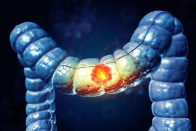 مصرف الکل خطر ابتلا به کدام سرطان‌ها را افزایش می‌دهد؟