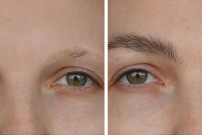 هزینه کاشت ابرو در تهران چقدر است؟ قیمت و تعرفه‌ها در سال ۱۴۰۴