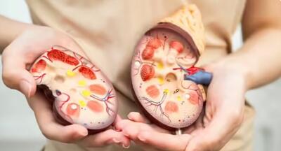  این مواد غذایی باعث تشکیل سنگ کلیه می‌شوند