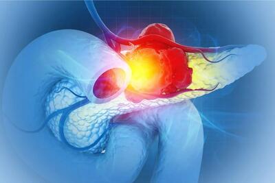  امید تازه برای درمان مقاوم‌ترین سرطان؛ دانشمندان تومورهای پانکراس را در موش‌ها نابود کردند