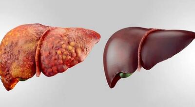  سرکه، آبغوره و ادویه برای کبد چرب خوب هستند یا بد؟