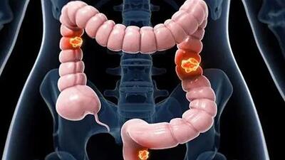  سرطان روده بزرگ: مهم ترین دلایل و پیشگیری