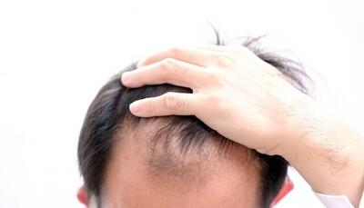 دلایل شایع ریزش مو