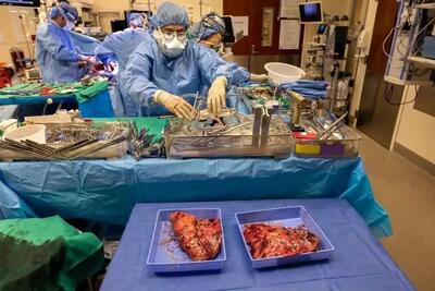  دستاورد پزشکان آمریکایی؛ چگونه یک بیمار ۴۸ ساعت بدون ریه زنده ماند؟