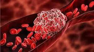 علائمی که می‌گویند خون شما در حال لخته شدن است/این ۷ علامت را جدی بگیرید