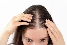  چرا موها می‌ریزند؟ دلایل شایع ریزش مو