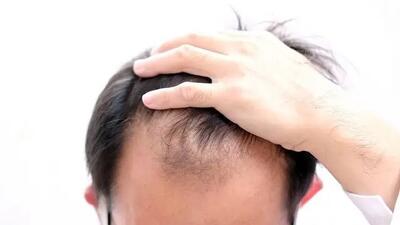 چرا موها دچار ریزش می شود؟ از علل تا درمان