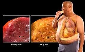 این ها مهم ترین عوامل برای کبد چرب  هستند!