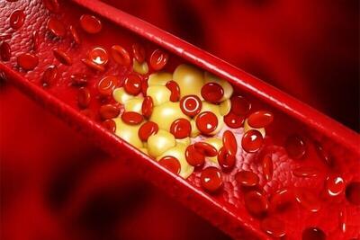 کلسترول بالا در جوانان؛ زنگ خطری که نباید نادیده گرفت