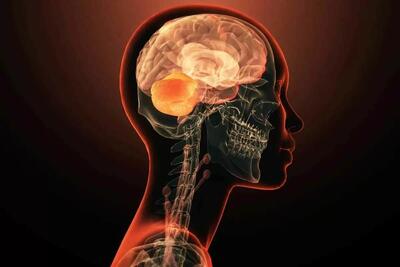  کشف ژنی که به تنهایی عامل بیماری های روانی است