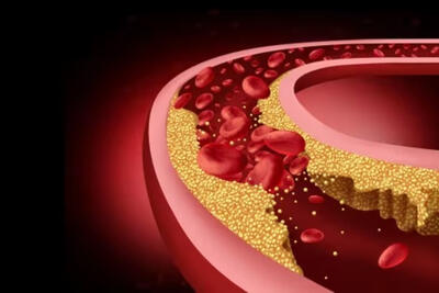 کلسترول بالا دیگر مخصوص سالمندان نیست؛ قاتل خاموش حالا سراغ جوان‌ها آمده!