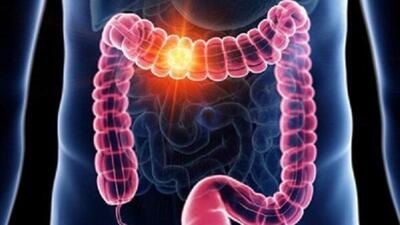  عوامل موثر در بروز سرطان روده / تغییر اجابت مزاج را جدی بگیرید