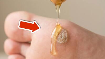  روش طبیعی یبرای از بین بردن میخچه کمتر از ۱ یک روز