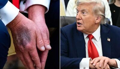  پیش بینی پزشک فیزیوتراپیست از بیماری ترامپ