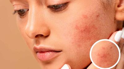  چه غذاهایی باعث التهاب پوست می شود؟ + توصیه های تغذیه ای برای پوست سالم