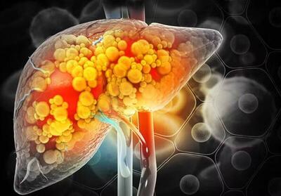  مصرف خودسرانه داروها از عوامل مهم آسیب به کبد