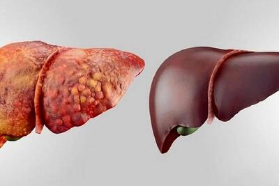  کبد چرب گرید ۲؛ نشانه ها و راه های درمان قطعی بدون دارو!