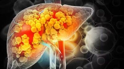  مصرف خودسرانه داروها از عوامل مهم آسیب به کبد  