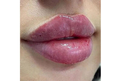  تزریق فیلر لب روسی؛ زیبایی ظریف، فرم عروسکی و ماندگار در کلینیک پارسیان بیوتی