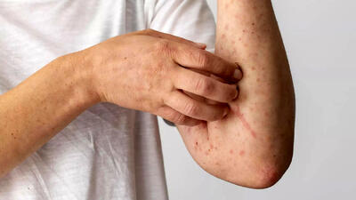 سندرم آلفا گال چیست؟+چه کسی در معرض خطر آلفا گال است؟