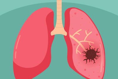  مصرف داروهای سرطان ریه در صبح، عمر بیماران را دو برابر می‌کند