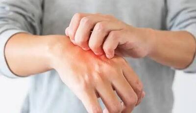  چگونه خارش ناشی از اضطراب را مدیریت کنیم؟