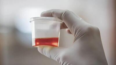  خون در ادرار همیشه خطرناک است؟