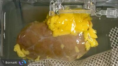  امید تازه برای بیماران در انتظار پیوند؛ کلیه‌ای که محدودیت گروه خونی ندارد ساخته شد