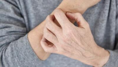  نشانه‌های پوستی که از بیماری خبر می‌دهند