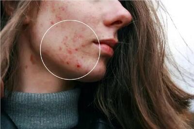  استفاده از ریزحباب‌ها برای مبارزه با آکنه‌های سرسخت