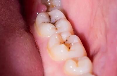  راز پوسیدگی دندان کشف شد